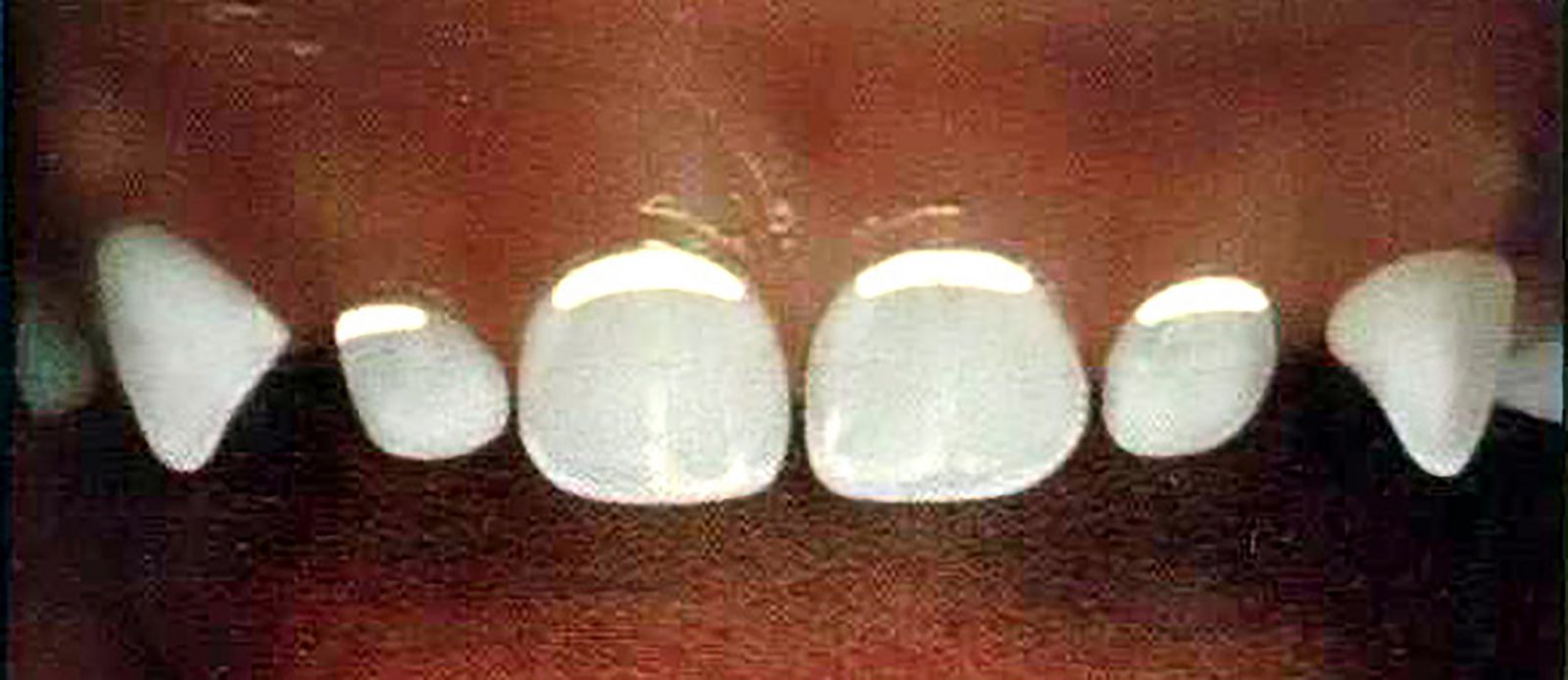 White Lines On Teeth By Gums TeethWalls